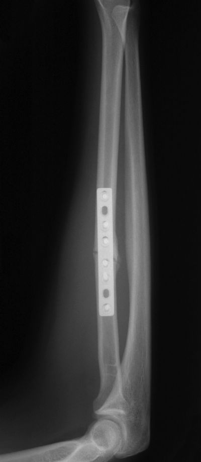 Radius & Ulna, Shaft:  Synthes DCP (Implant 264)